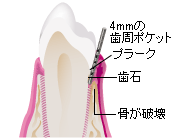 ４ｍｍ以上のポケットが形成され歯石の沈着が起こり骨の破壊が進む