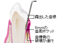 6mm以上のポケットになり骨の破壊が進行しています